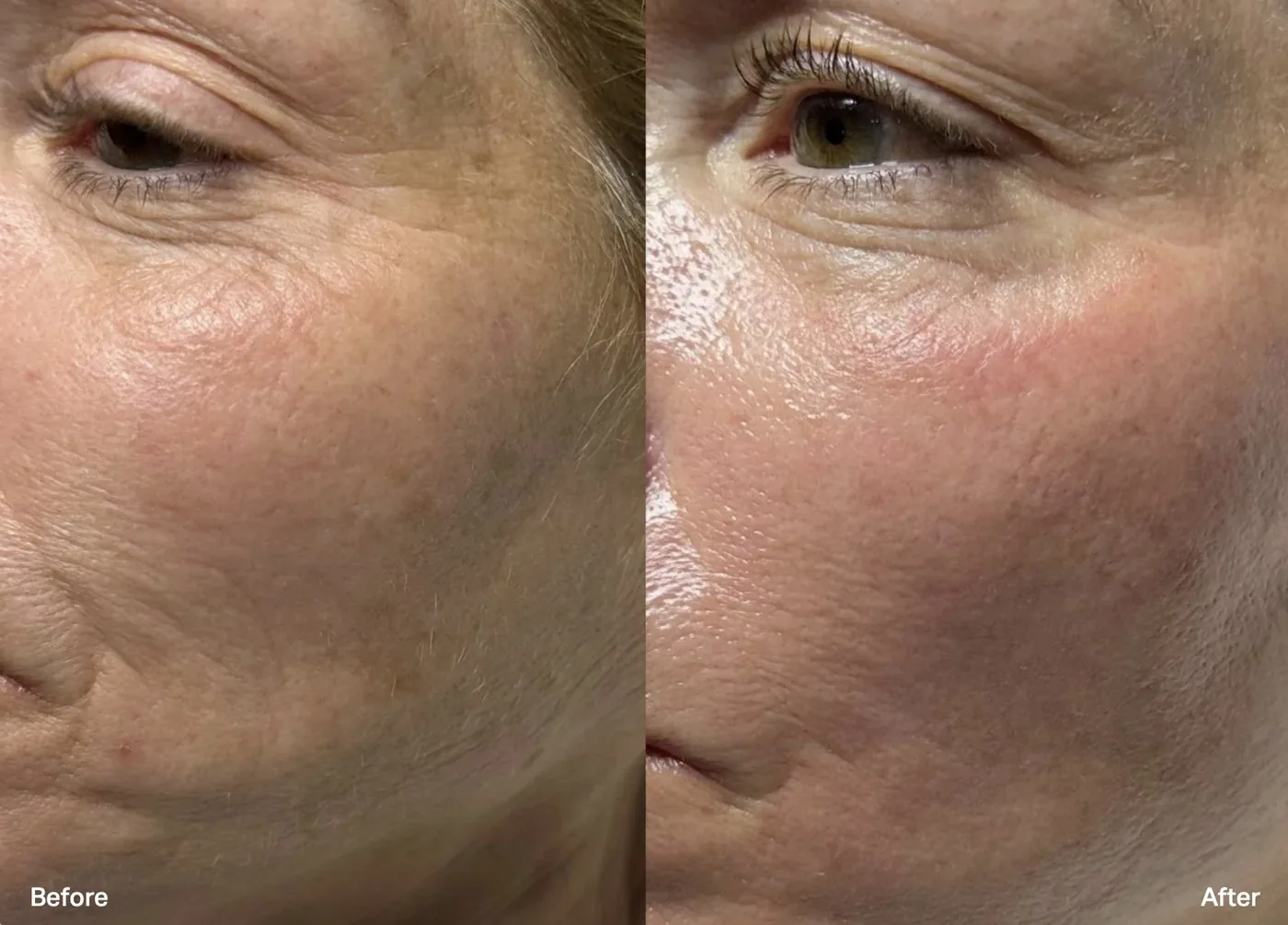 Before and after a Hydrafacial at The Dew Bar